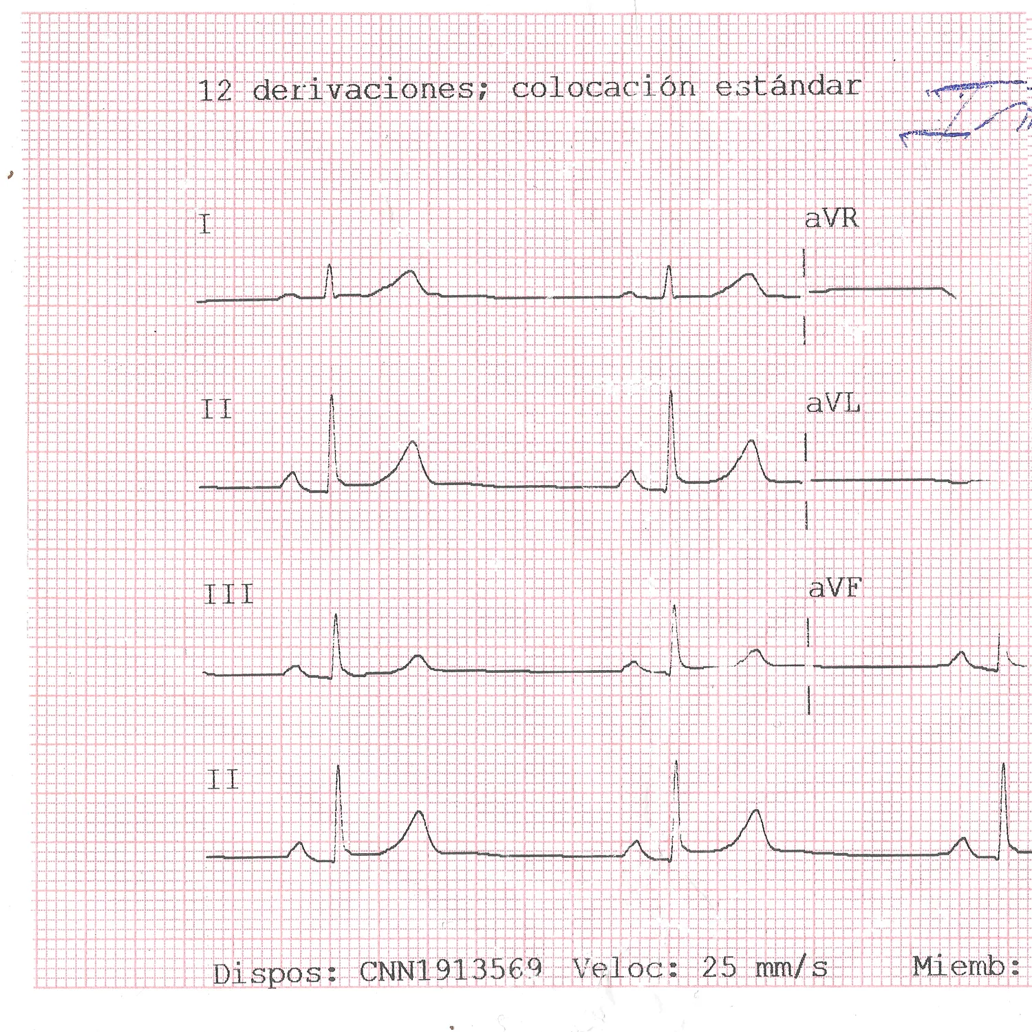 Scan of an electrocardiogram strip printed on pink squared paper, with the leads I, II, III, aVR, aVL and aVF labelled